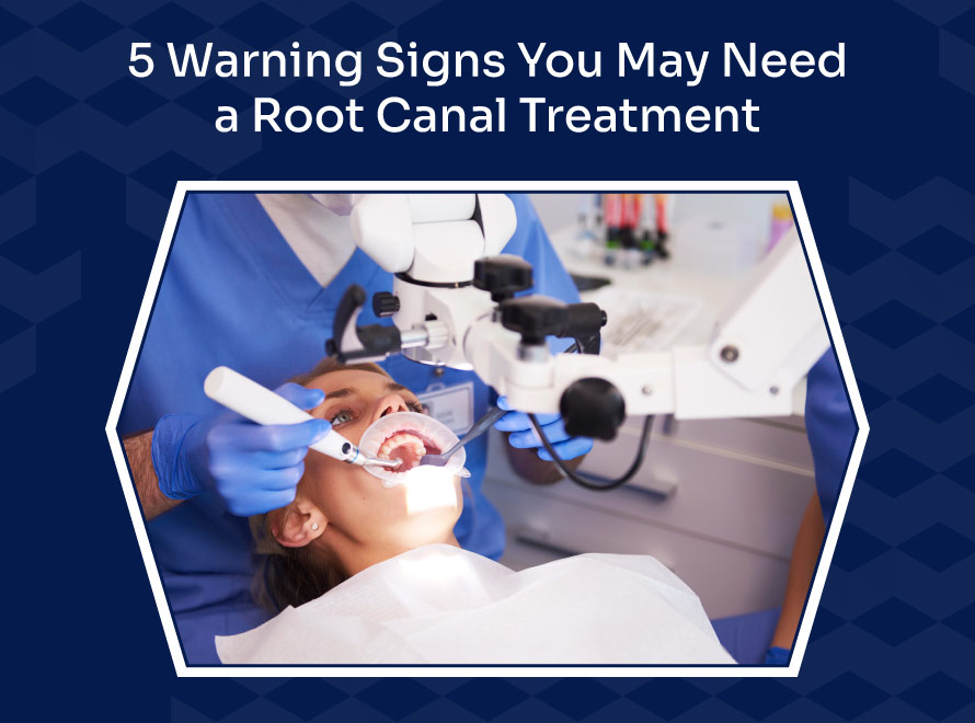 Signs You May Need a Root Canal Treatment