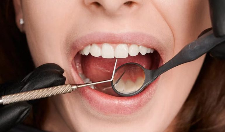Advanced-Gum-Treatments