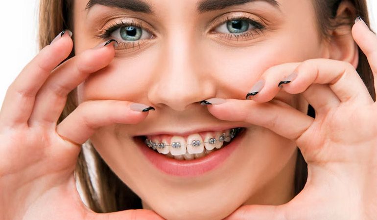 Braces-and-Aligners