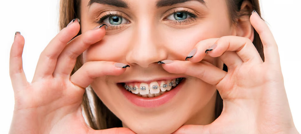 Braces-and-Aligners