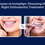 Braces vs Invisalign