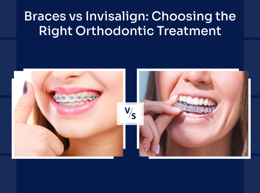 Braces vs Invisalign