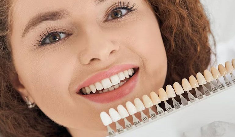 Celebrity-Smile-Makeover