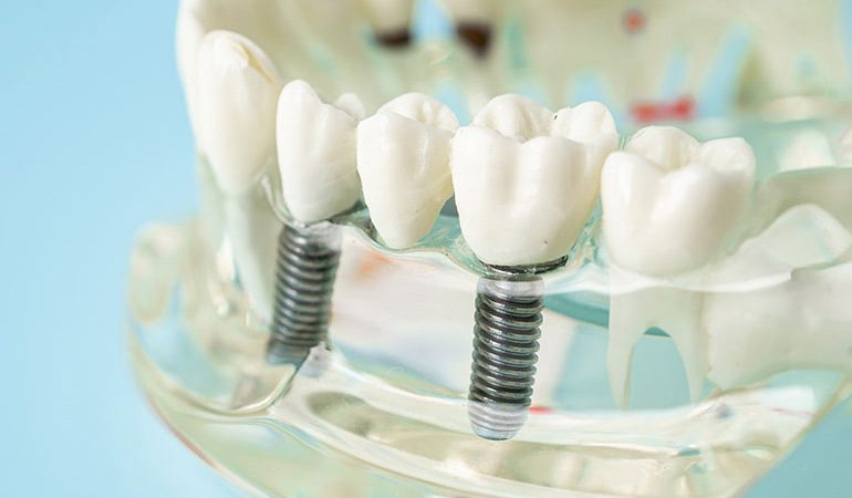 Dental-Implants