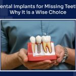 Dental Implants for Missing Teeth