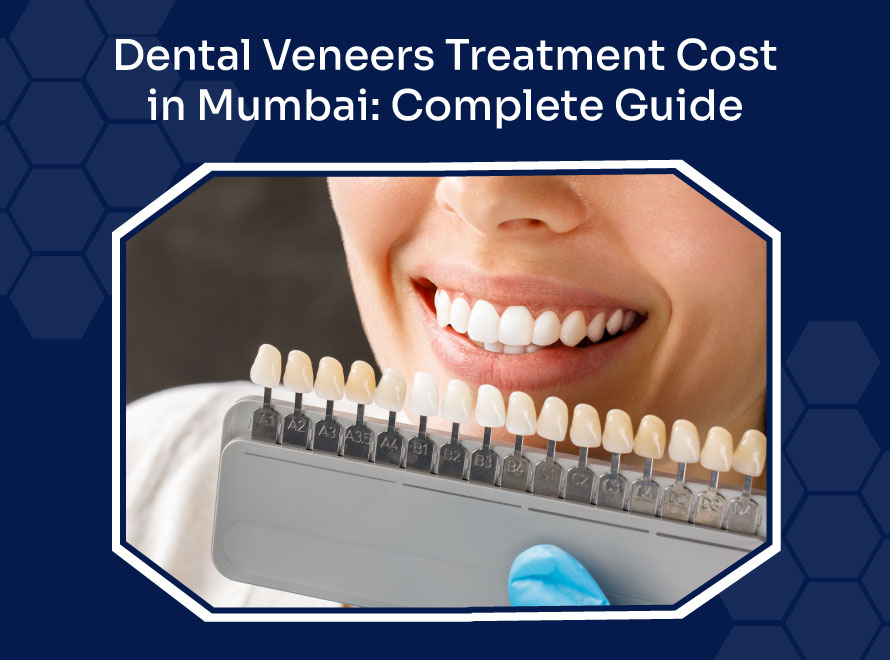Dental Veneers Treatment Cost in Mumbai: Complete Guide