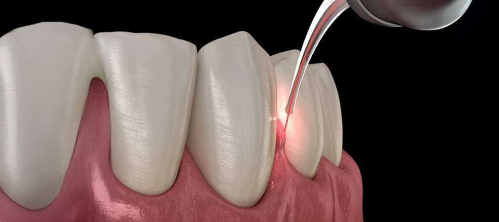 Laser Dentistry