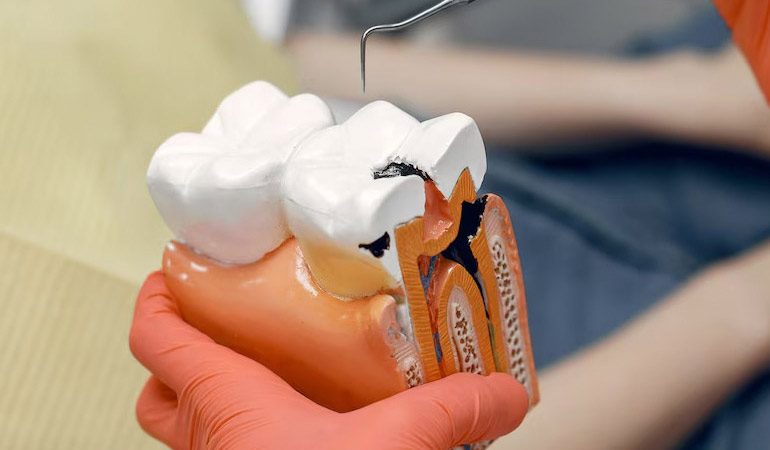 Root-Canal-Treatments