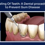 Scaling of Teeth: A Dental Procedure to Prevent Gum Disease