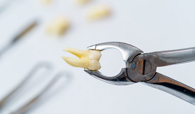 Wisdom-Tooth-Extraction