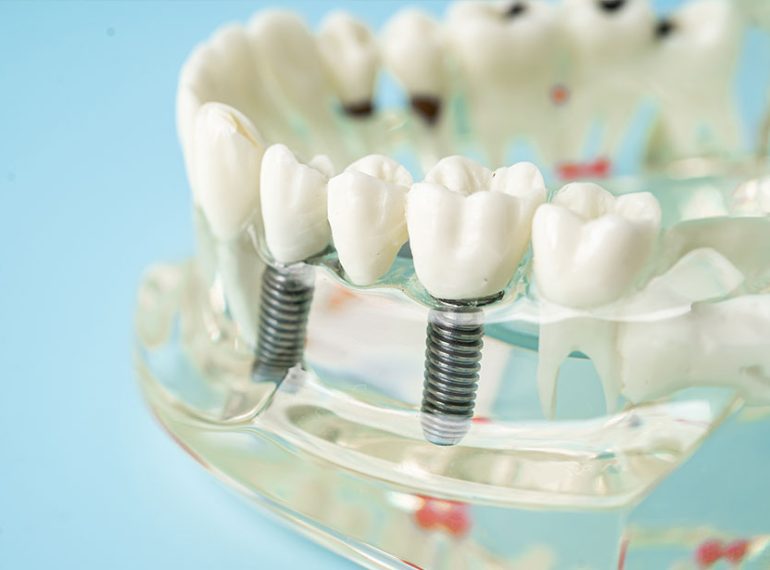 dental implants