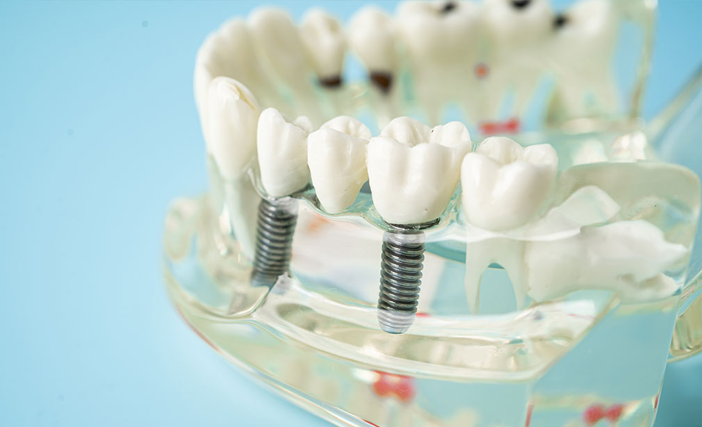 dental implants